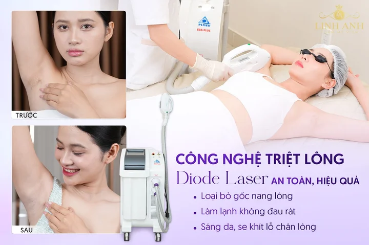 Thẩm mỹ viện Linh Anh - Địa chỉ triệt lông Diode Laser uy tín tại Quận 10