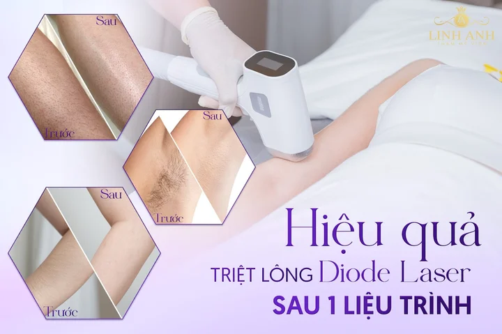 Thẩm mỹ viện Linh Anh - Địa chỉ triệt lông Diode Laser uy tín tại Quận 10