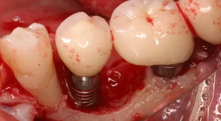 N&ecirc;n ki&ecirc;ng rượu bia trong bao l&acirc;u trước khi cấy gh&eacute;p Implant?